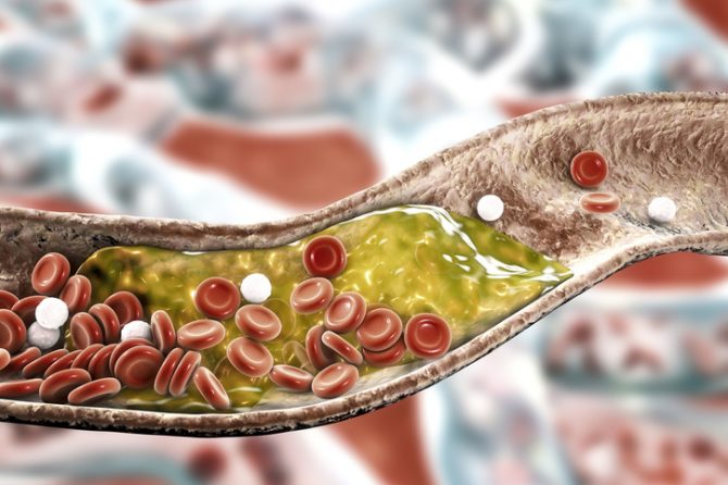 alimentos que debes evitar si tienes el colesterol alto