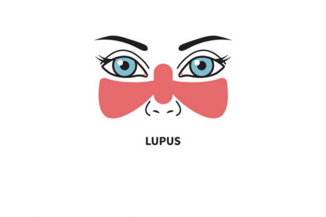 Síntomas del lupus