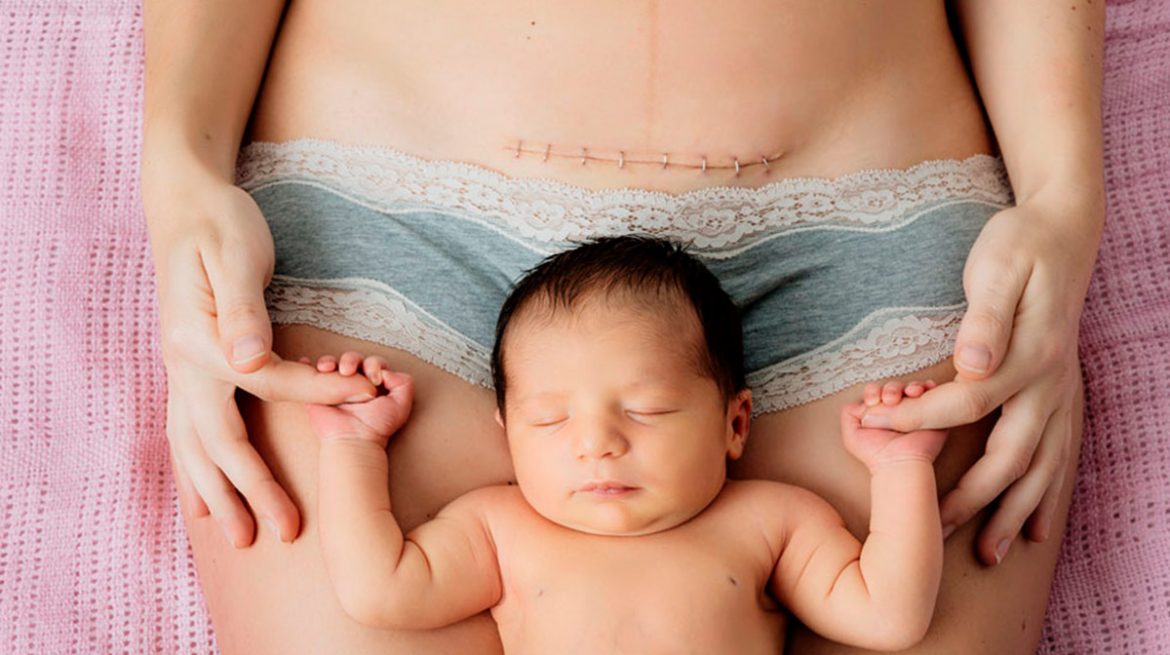 Qué comer después de una cesárea