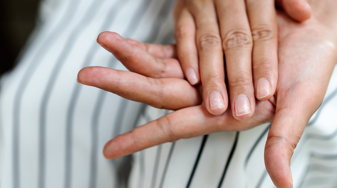 Padrastros de las uñas