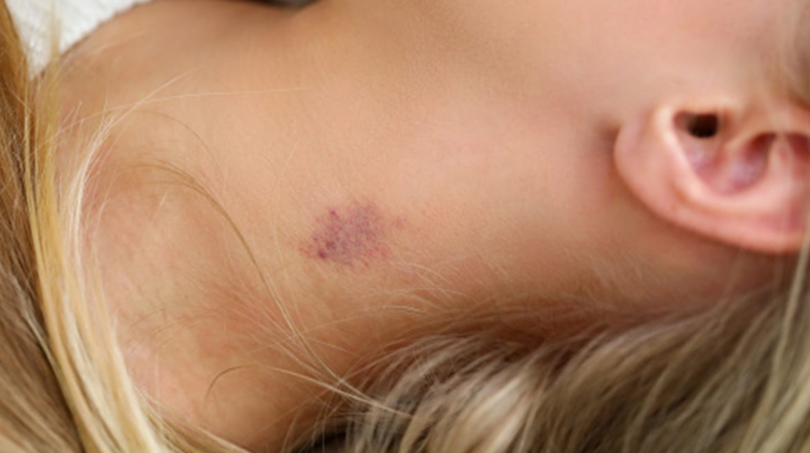 Cómo quitar chupetones